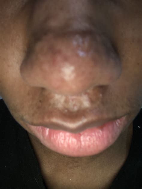 Raised Hypertrophic Nose Acne Scars Help Me Plzzz Hypertrophic Raised Scars