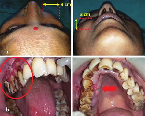 Extra Oral Examination Of The Swelling Present On Right Side Upper