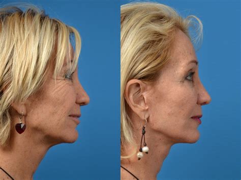 Facelift Photos Melbourne Fl Patient 52551