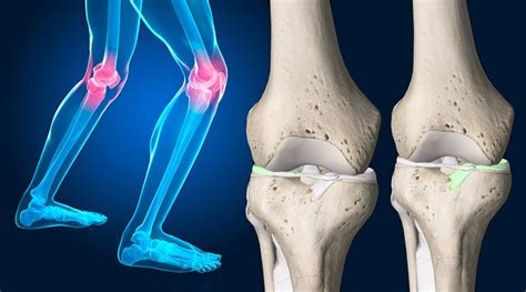 rotura de meniscos de la rodilla causas síntomas y tratamiento la 621