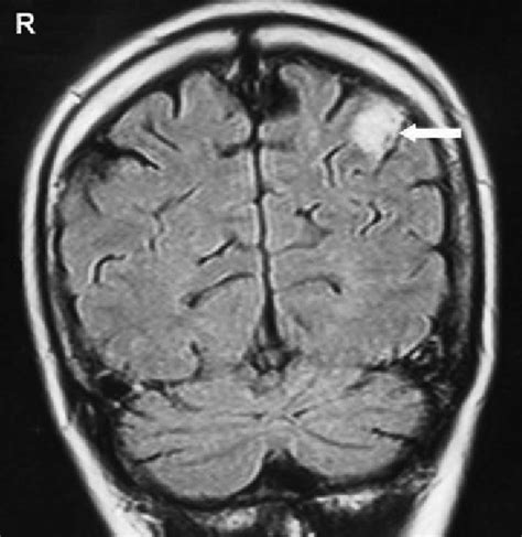 Left Parieto Occipital Cortical Hyperintense Lesion Suggesting Ischemia