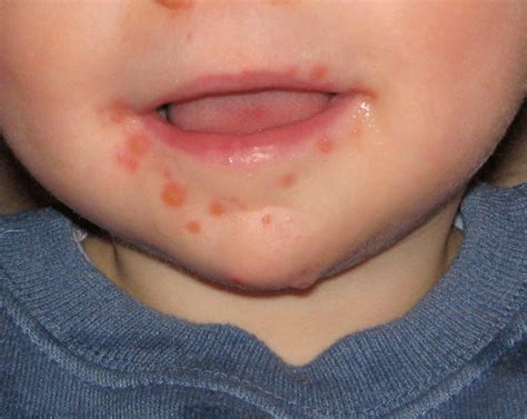 hand foot and mouth disease hfmd symptoms and treatment medtravel asia