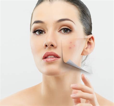 Learn How To Finally Get Rid Of Acne Scars Medscar