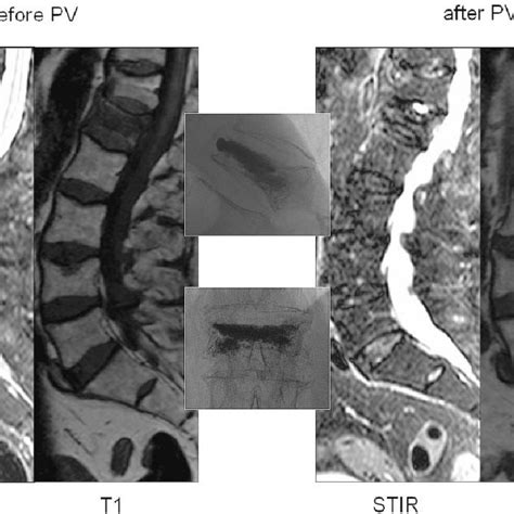 Osteoporotic Vertebral Compression Fracture Of L2 With Absent Bone