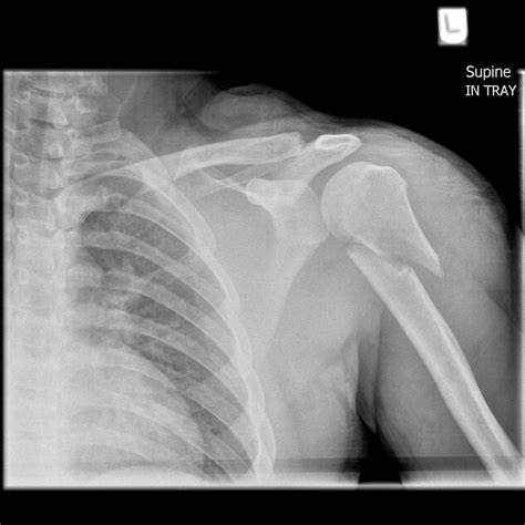 Distal Humeral End Fractures Image Radiopaedia Org My Xxx Hot Girl