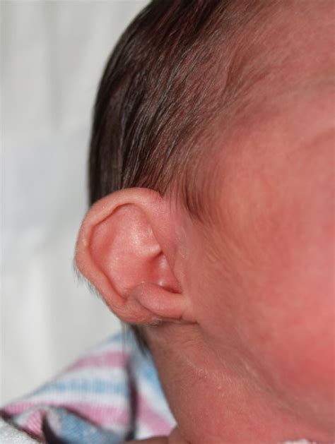 Ears Newborn Nursery Stanford Medicine