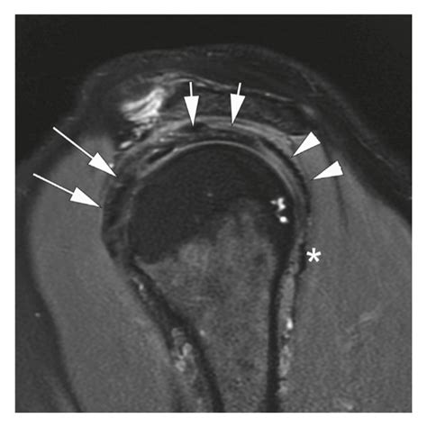 Normal Mri Of The Right Shoulder Axial T2 Weighted Fat Suppressed Fs