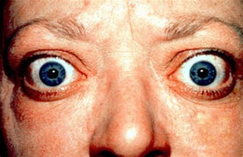 Difference Between Graves Disease And Hashimoto Compare The