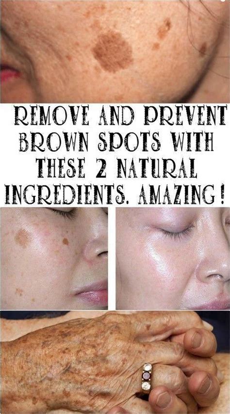 How To Get Rid Of Darkish Spots On Deal With Right Away Brownagespots