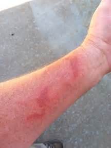 Fig Sap Skin Burn Pictures