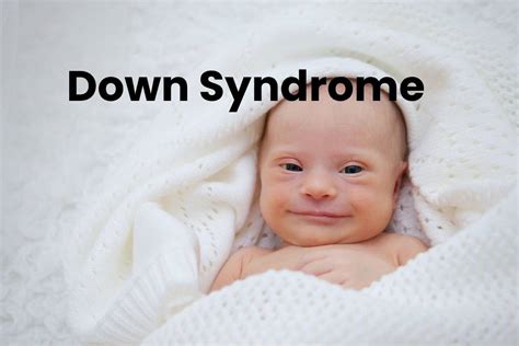 down syndrome definition facts statistics types and more