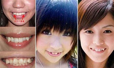 Por Qual Motivo Os Dentes Yaeba São Tão Populares No Japão