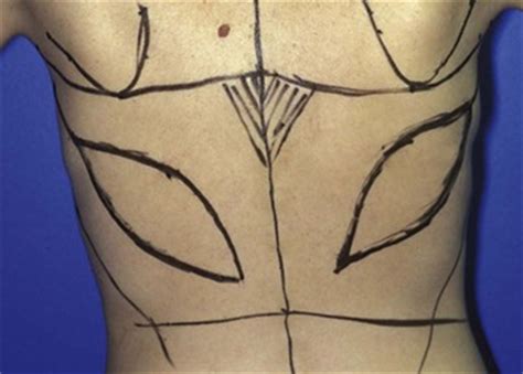 Latissimus Dorsi Flap Breast Reconstruction Clinical Gate