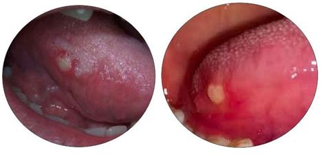 Picture Of Bump On Side Of Tongue Tongue Bumps On Tongue Tongue