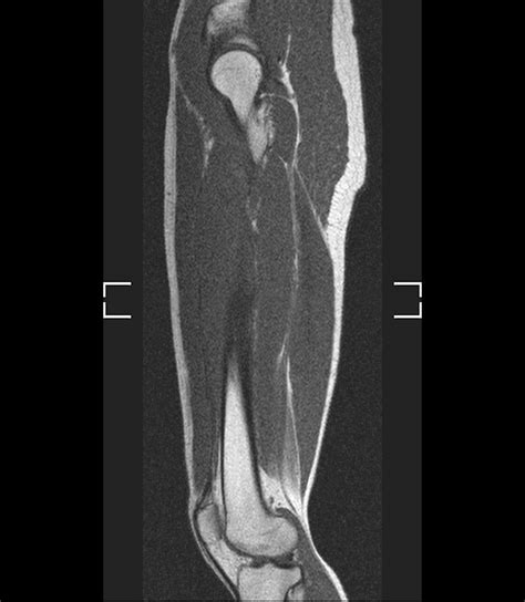 Normal Mri Of The Thigh Image
