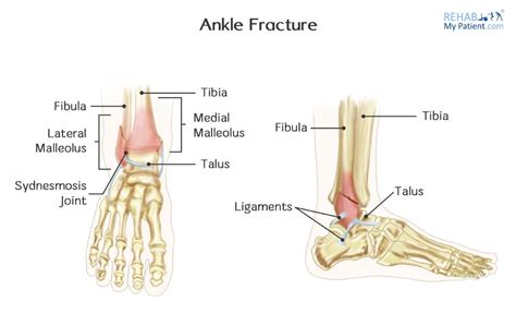 Ankle Fractures In Children Rehab My Patient