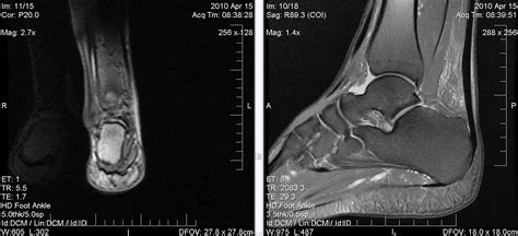 It arises from the base of the fifth metatarsal bone, and from the sheath of the fibularis longus. Magnetic Resonance Imaging Mri For Foot Ankle Pain | Party Invitations Ideas
