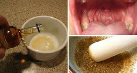 Cure Tonsillitis And Sore Throat Overnight With This Natural Ingredient