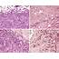 Mast Cells In Invasive Breast Cancer Low A And High B 