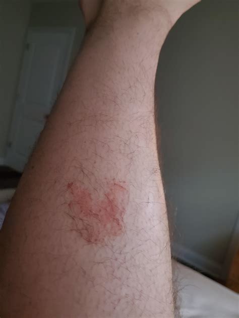 Rash On Leg Tried Hydrocortisone Lotramine Ultra And Other Fungal