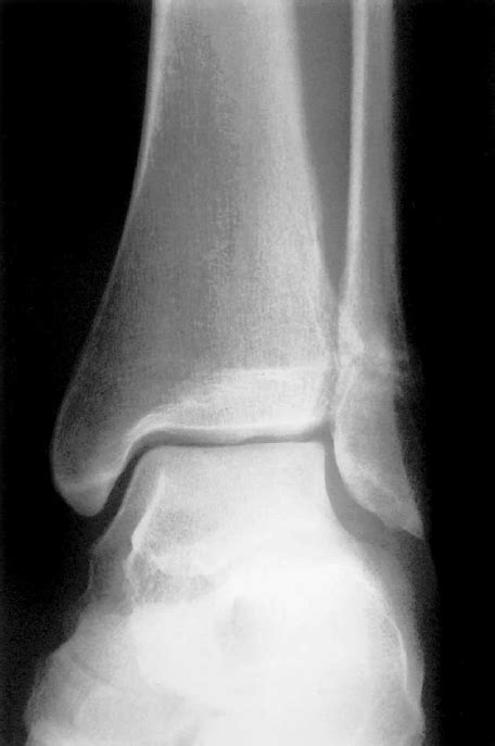 Radiograph Of Left Ankle Showing The Fracture Of The Distal Fibula