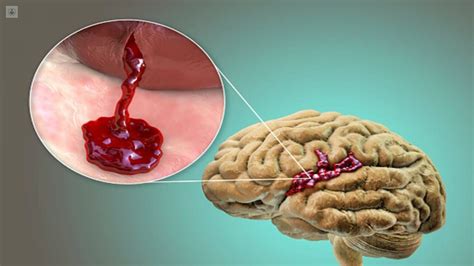 Hemorragia Cerebral Causas síntomas y tratamiento Top Doctors