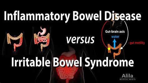 Inflammatory Bowel Disease Vs Irritable Bowel Syndrome Animation Youtube