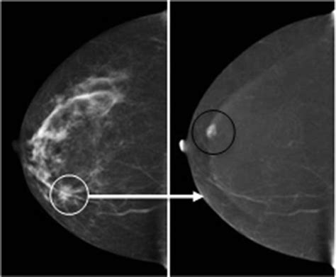 Contrast Enhanced Spectral Mammography Academic Radiology