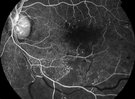 Branch Retinal Vein Occlusion Ischemic The Retina Reference