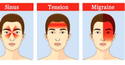 Sakit kepala tension lebih sering diderita oleh wanita dibanding pria. Kenali 5 Jenis Sakit Kepala Ini..