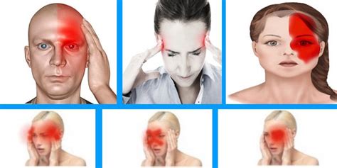 sabias que esisten diferentes tipos de dolores de cabeza y tratamientos ~ formulas para vivir