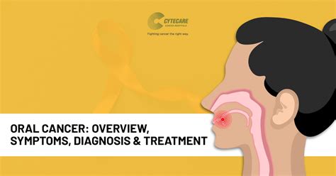 Mouth Cancer Overview Symptoms Diagnosis And Treatment Cytecare
