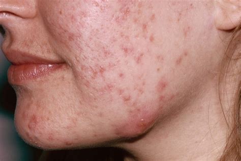 International Guidelines For Treatment Of Mild To Moderate Acne An