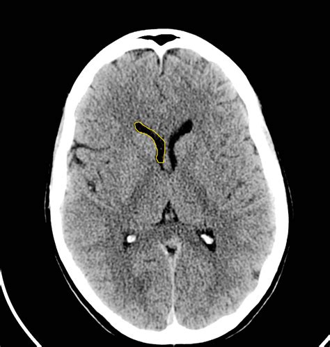 Head Ct Scan Labeled