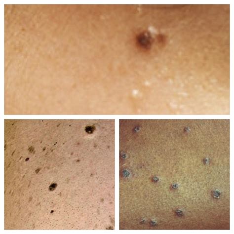 Black Spots On Skin Face And Body Causes And Treatment