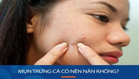 Mụn Trứng Cá ở Quanh Môi Dấu Hiệu Nhận Biết