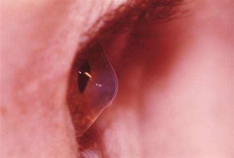 Keratoconus 2 Hereditary Ocular Diseases