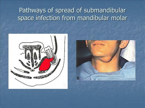 Ppt Diagnosis And Management Of Acute Infections Powerpoint