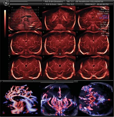 Tomographic Ultrasound Imaging Tui And 3d Reconstructed Intracranial