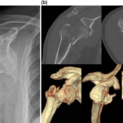 Reduction And Fixation Of The Glenoid Fracture Severe Comminution Of