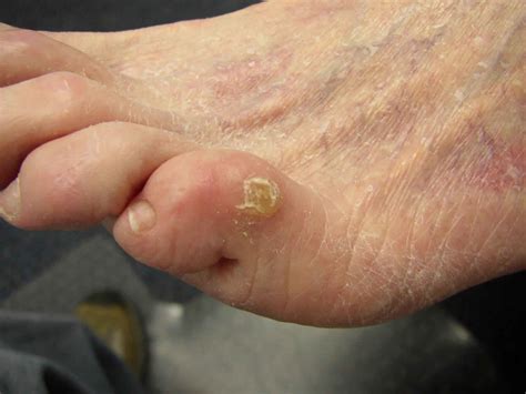 In biological research and biotechnology callus formation is induced from plant tissue samples (explants). Corns and calluses on feet and learn how to get rid of ...