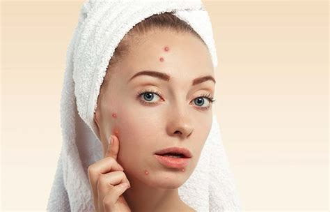 Why do we get pimples? How To Prevent Pimples And Acne Naturally: Tips And Home ...