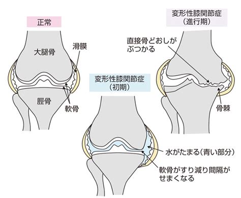 変形性膝関節症の治療│近畿大学病院