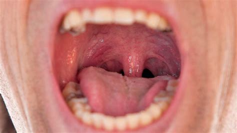 World First Saliva Test Detects Hidden Throat Cancer Mirage News