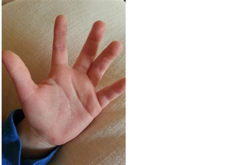 Fibrous Hamartoma Of Infancy At The Hand A Case Report With Complications