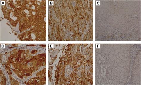 Representative Examples Of P16ink4a Immunostaining In Psccs A Hpv