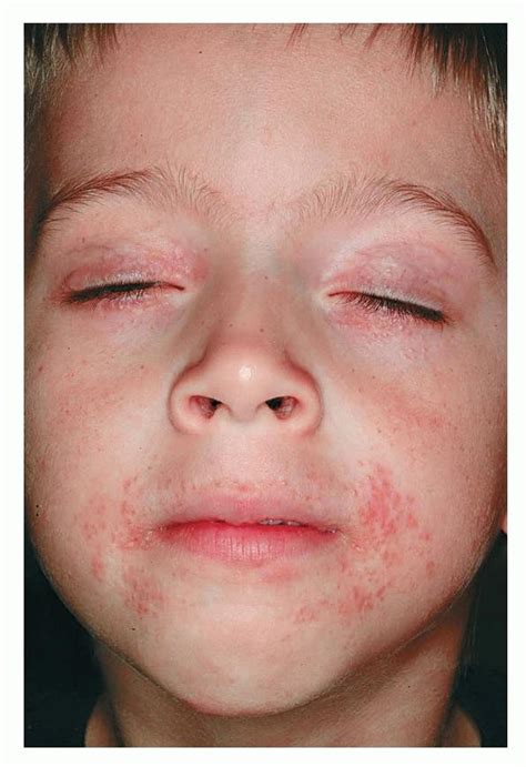 Perioral Dermatitis Child
