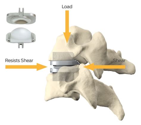 Artificial Disc Replacement Oregon Spine Care