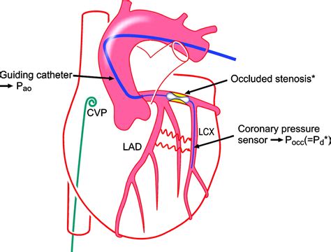 Assessment Of The Human Coronary Collateral Circulation Circulation
