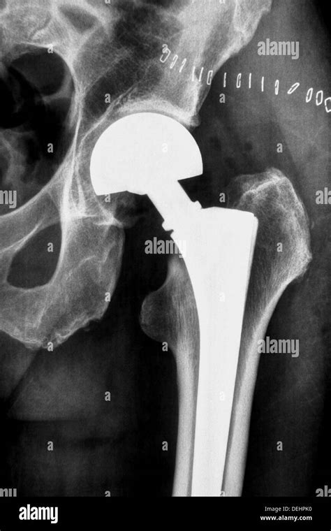 Hip Prosthesis Hi Res Stock Photography And Images Alamy